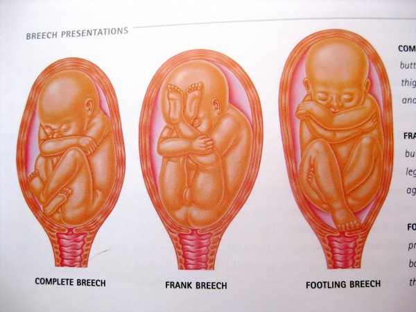 различни типови на карлична поставеност на бебето